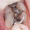 a molar with an old, silver amalgam filling | tooth colored fillings in st petersburg