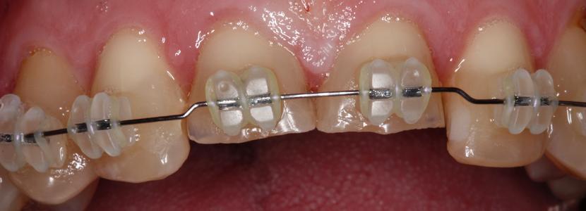 teeth during a short term orthodontic treatment | st petersburg fl dentist