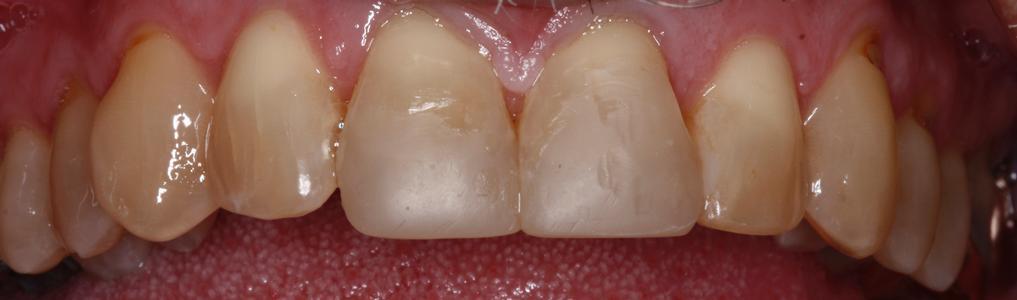 teeth following short term orthodontics | dentist st petersburg