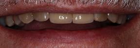 two dental crowns sitting on worn teeth, restoring their look and function | st petersburg dental crowns