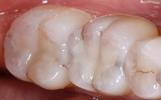 teeth after silver fillings have been removed and new tooth colored composite fillings have been placed | dental fillings st petersburg