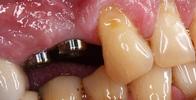 Dental-Implants-Before-Image