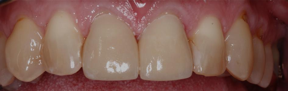 teeth following additional filling placed on after short term orthodontics | st petersburg dental fillings