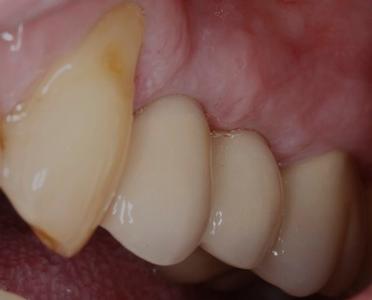 teeth after implant crowns have been placed, restoring look and function | st petersburg dental implants