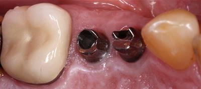a bottom-up view of a patients mouth with dental implant posts | dental implants in st petersburg fl