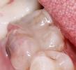 a molar that has had it's silver amalgam fillings removed, and replaced with tooth-colored fillings | st petersburg dental filligns