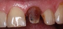 All-Ceramic-Crown-Before-Image
