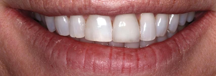 another view of a ceramic crown that has been placed on a patient's tooth for cosmetic reasons | crowns in st petersburg