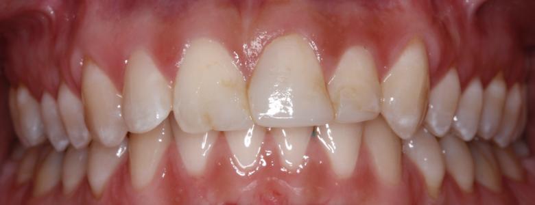 a person's mouth before dental crowns | dental crowns st petersburg fl