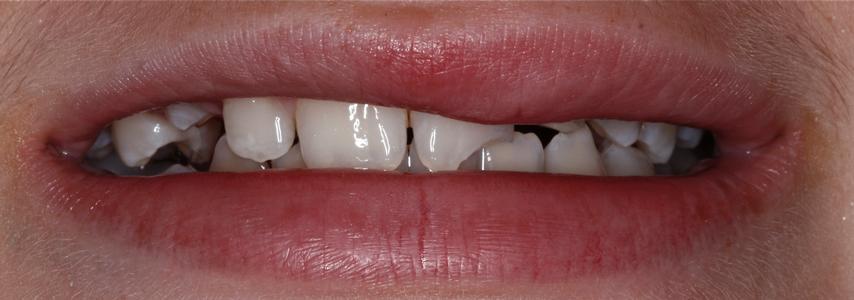 a chipped font tooth | dental fillings st petersburg fl