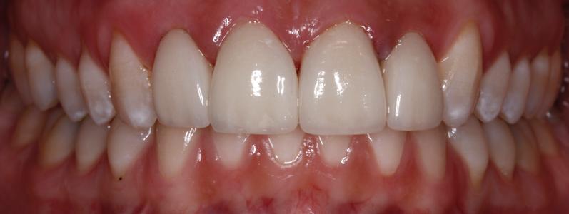 a person's mouth after crowns | st petersburg dental crowns