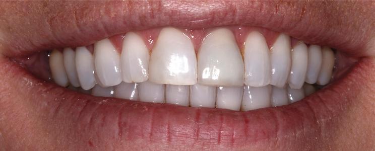 a tooth after having a ceramic crown placed | st petersburg dental crowns