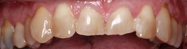 teeth before short term orthodontics | dentist in st petersburg