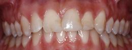 All-Ceramic-Crowns-Before-Image