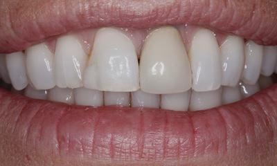 a tooth before a ceramic crown | dental crowns in st petersburg