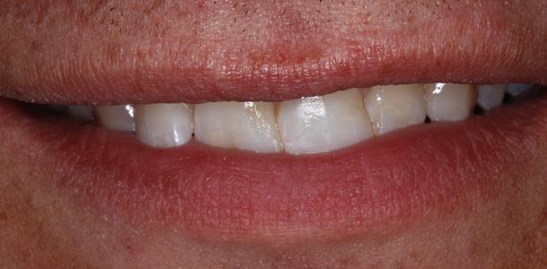 a smile before crowns | dental crowns in st patersburg fl