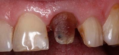 a decaying tooth before a dental crowns | dental crowns in st petersburg fl