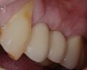 Dental-Implants-After-Image