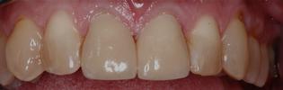 teeth following additional filling placed on after short term orthodontics | st petersburg dental fillings