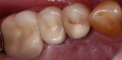 a bottom-up view of a mouth after crowns have been placed on implant posts restoring apperance and use to this person's mouth | st petersburg fl dental implant dentist