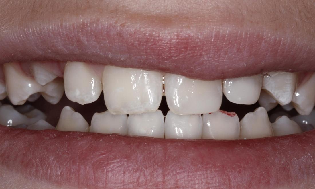 a fractured front tooth, fixed with composite resin | st petersburg restorative dentist