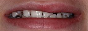 Composite-Fillings-Before-Image