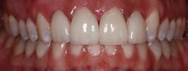 All-Ceramic-Crowns-After-Image