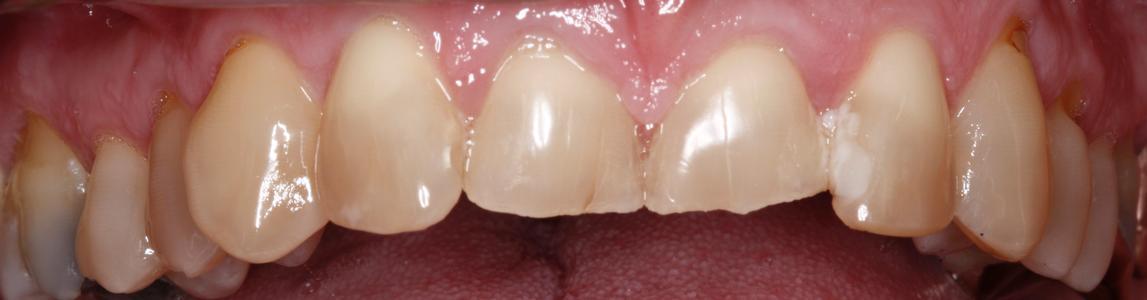 teeth before short term orthodontics | dentist in st petersburg