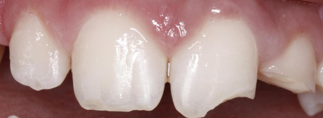 a fractured front tooth | restorative dentist st petersburg fl