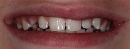 Composite-Fillings-After-Image