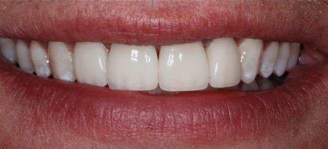 a smile after dental crowns | dental crowns st petersburg fl