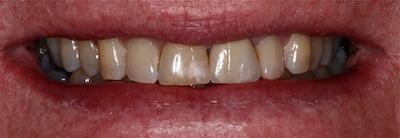 a tooth that has had a dental crown placed on it restoring it's look and function | st petersburg dental crown dentist