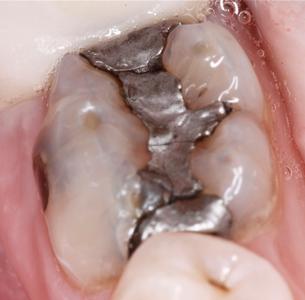 a molar with an old, silver amalgam filling | tooth colored fillings in st petersburg