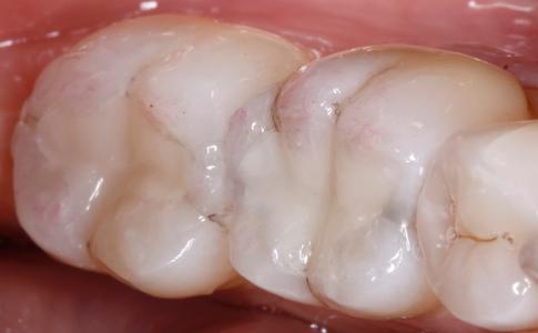 teeth after silver fillings have been removed and new tooth colored composite fillings have been placed | dental fillings st petersburg