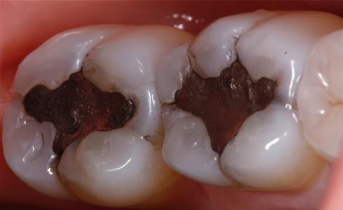 two molars with old silver fillings | tooth colored fillings st petersburg