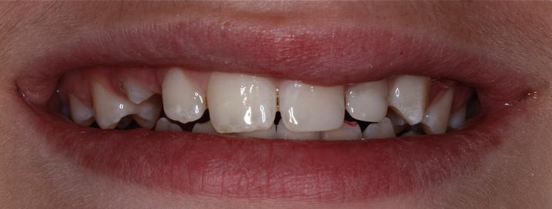 a chipped front tooth, fixed with composite resin | st petersburg fl dental fillings