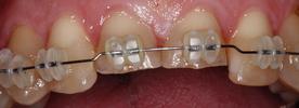 teeth during a short term orthodontic treatment | st petersburg fl dentist