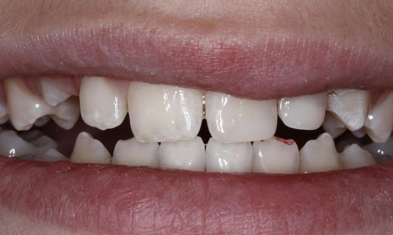 Composite-Fillings-After-Image